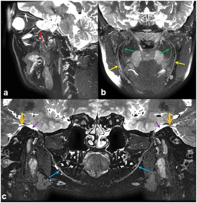 Deep learning-driven MRI trigeminal nerve segmentation with SEVB-net